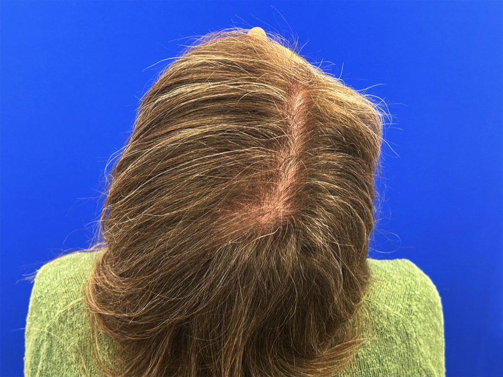 Women's Hair Restoration Program