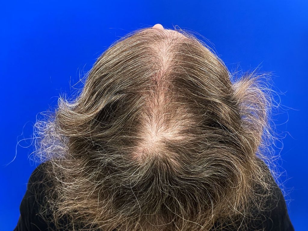 Women's Hair Restoration Program