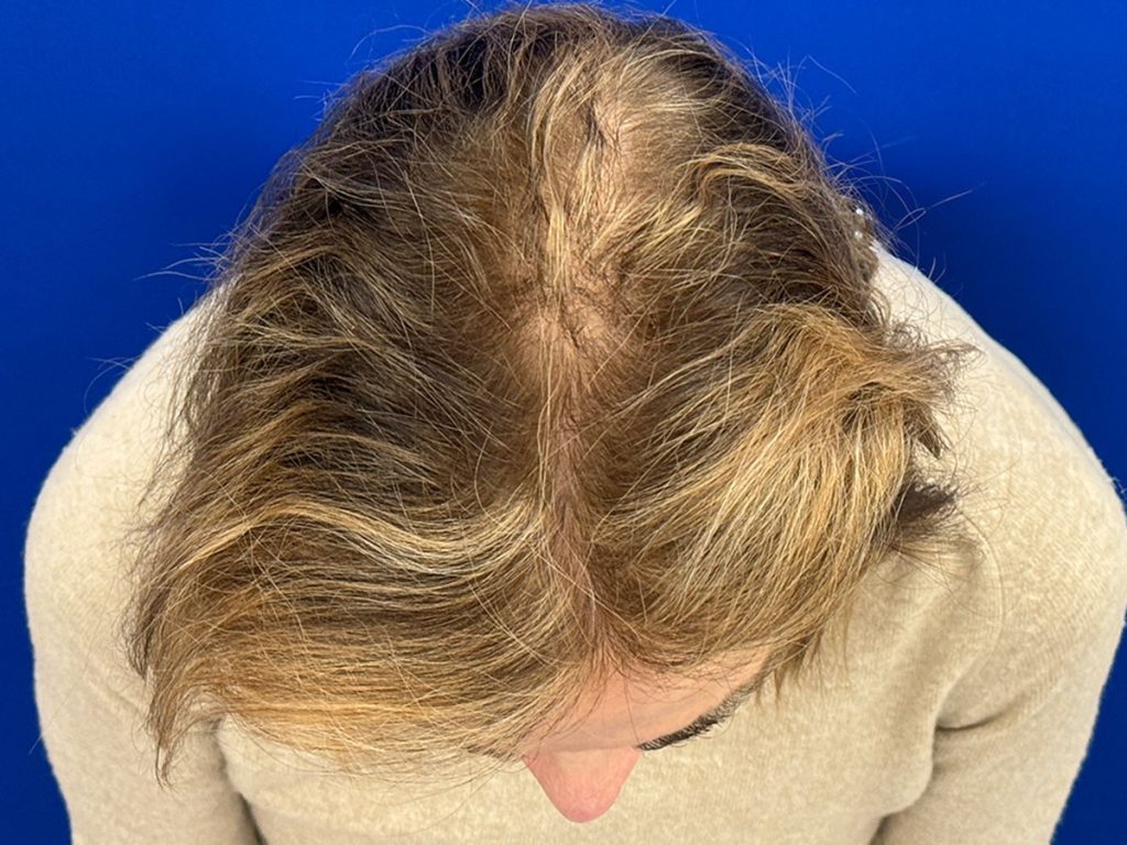 Women's Hair Restoration Program