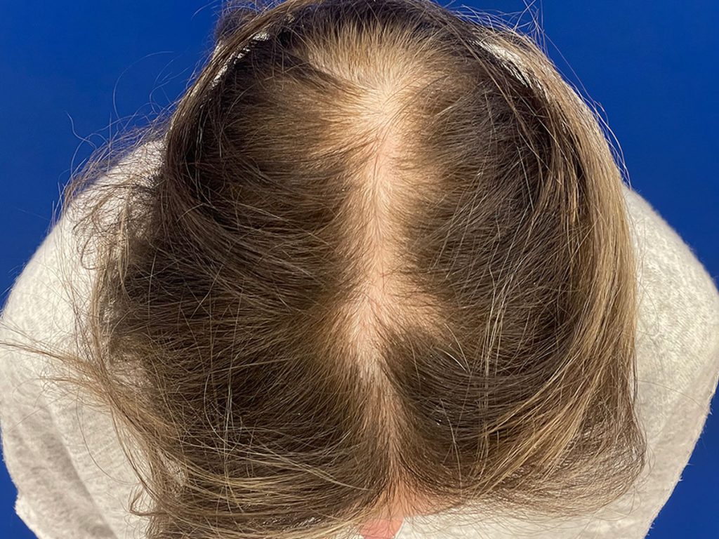 Women's Hair Restoration Program