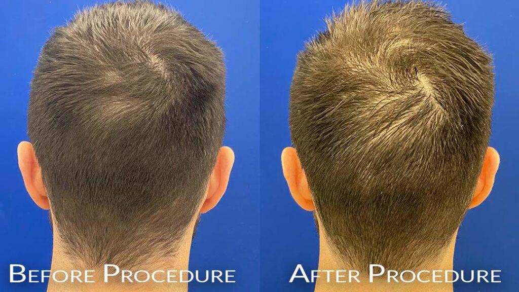 before & after fue hair restoration chicago il