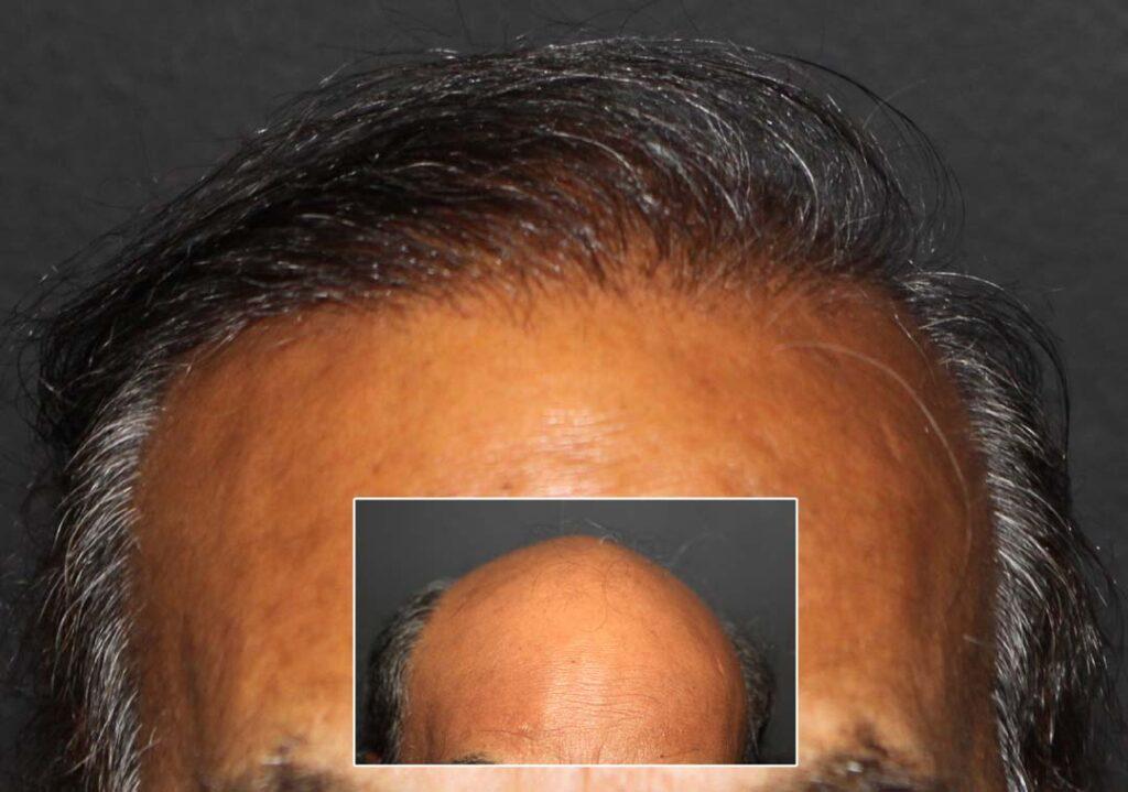 fue hair transplant