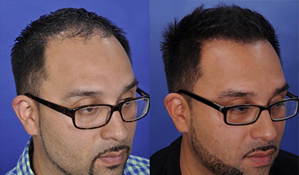 fue after & before