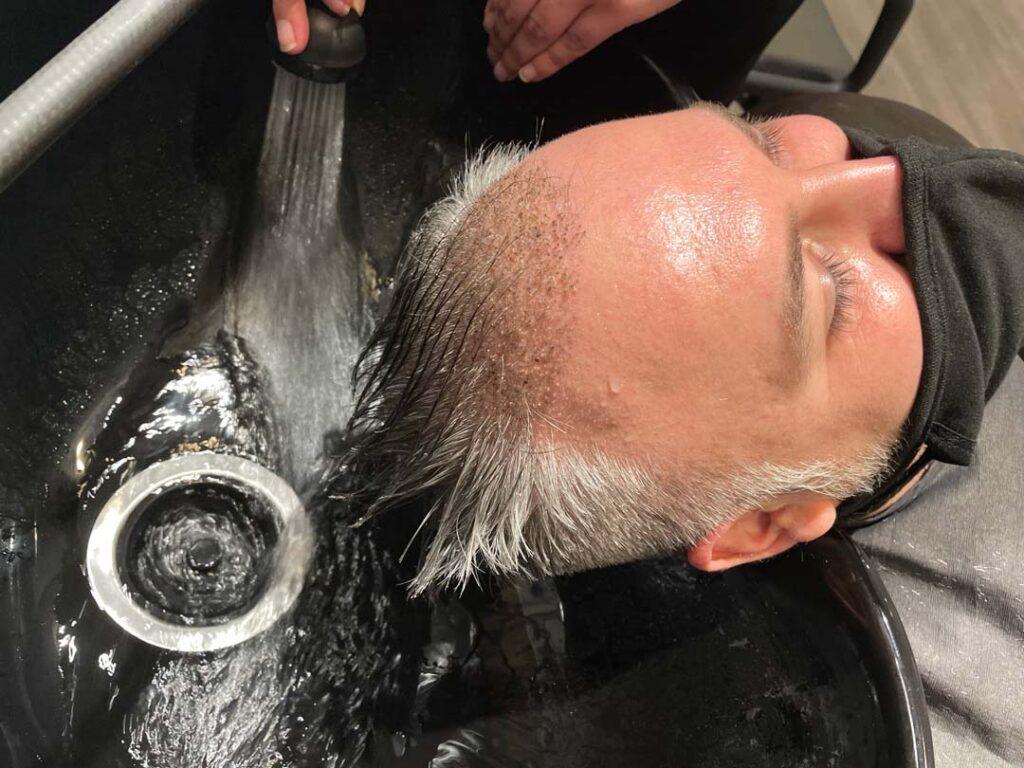 top fue hair restorartion chicago IL