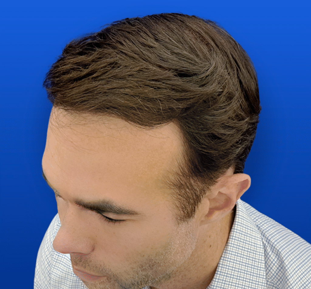 Men's Surgical Hair Restoration
