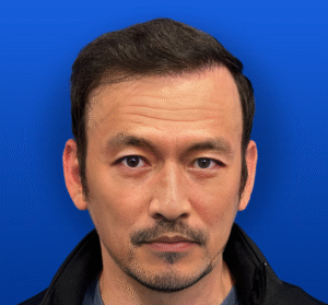Men's Surgical Hair Restoration