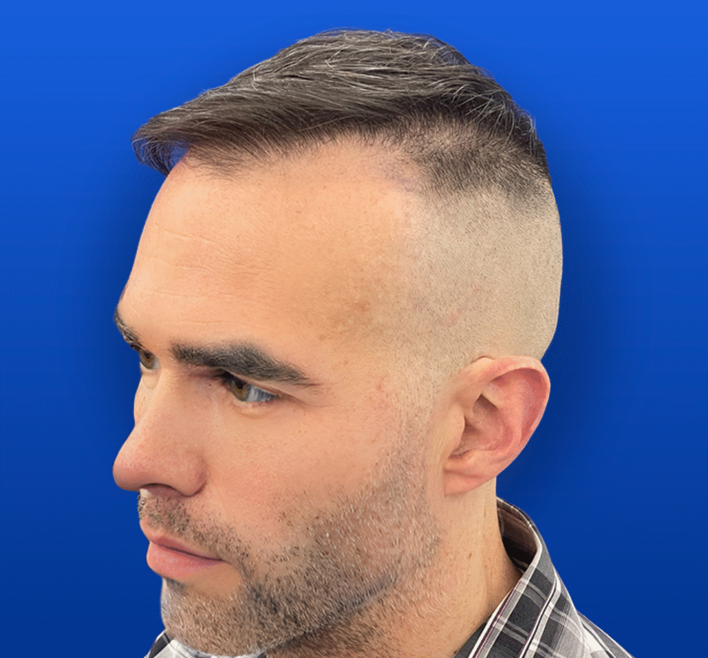 Men's Surgical Hair Restoration