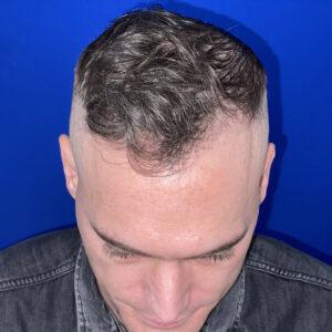 Hair Transplant Specialists | Northwestern Hair Restoration