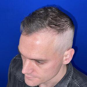 Hair Transplant Specialists | Northwestern Hair Restoration