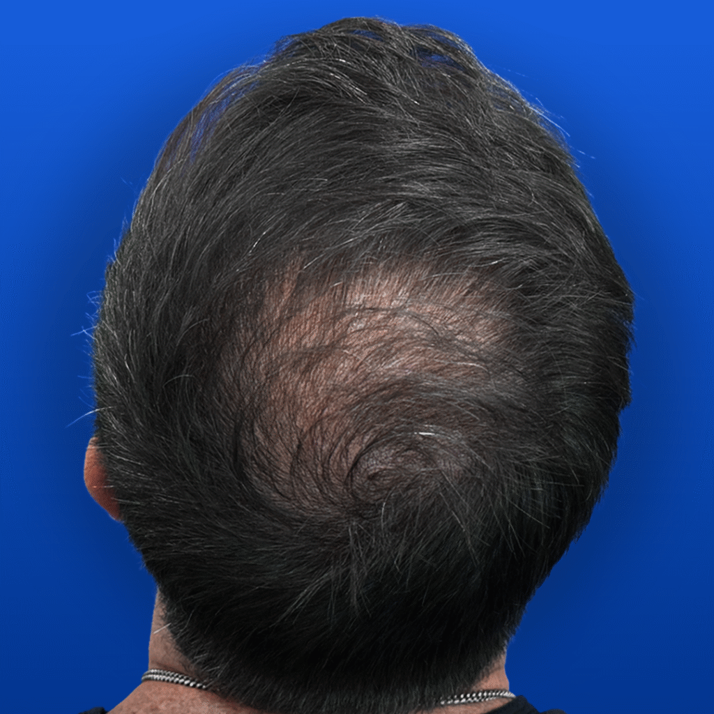 Men's Non-Surgical Hair Restoration