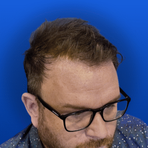 Men's Surgical Hair Restoration