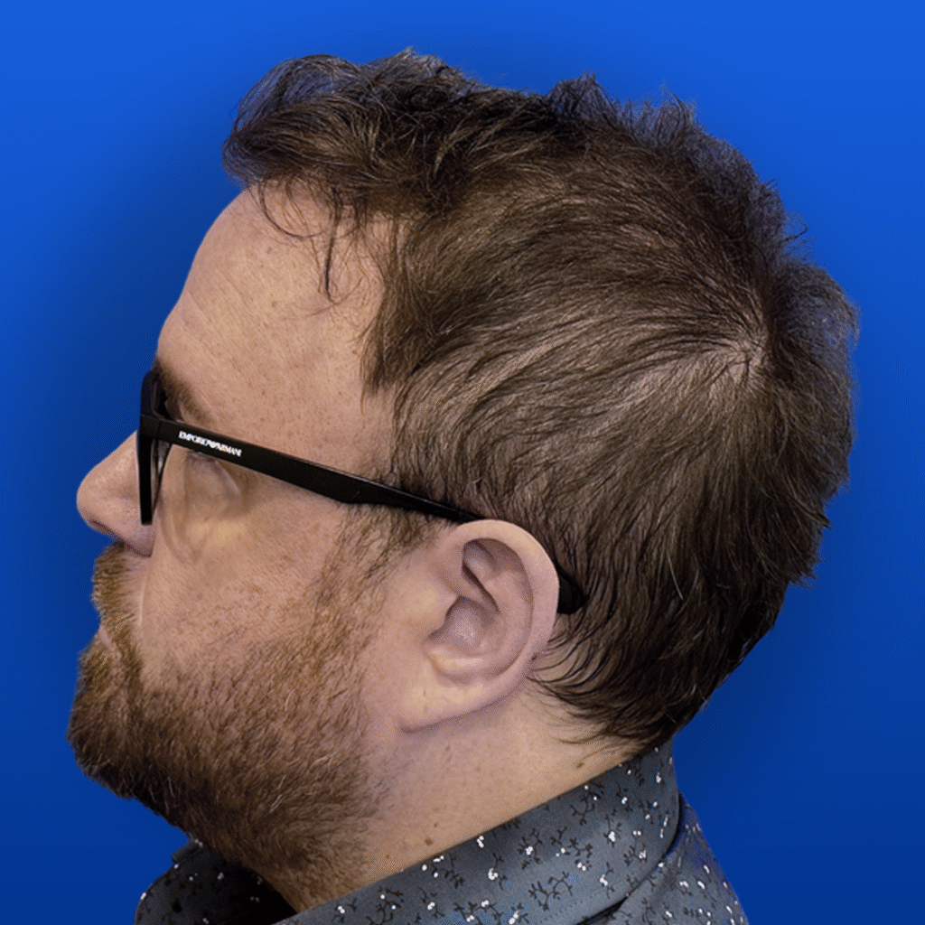 Men's Surgical Hair Restoration