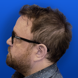 Men's Surgical Hair Restoration