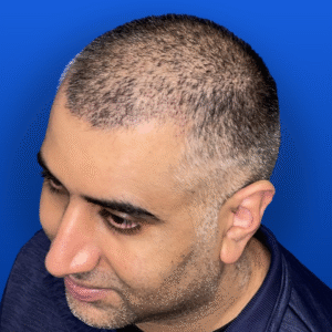 Men's Surgical Hair Restoration