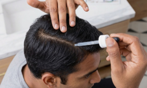 Oral Vs. Topical Minoxidil: Pros, Cons, And What To Expect
